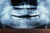Osteonecrosis of jaw risk highest for IV bisphosphonate use