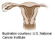 Outpatient uterine polypectomy more cost-effective