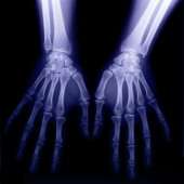 Overweight, obesity increase risk of carpal tunnel syndrome
