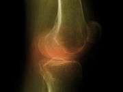 关节炎膝关节置换术后疼痛减轻，功能增强