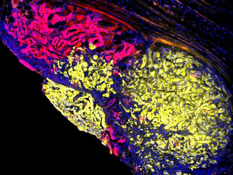 Pancreas cancer spread from multiple types of wayward cells