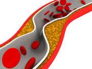 PCI may not improve survival for some heart disease patients