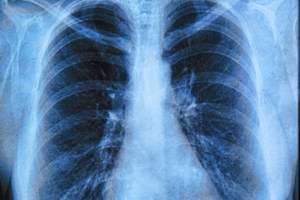 Personalised web advice for those who suspect lung cancer
