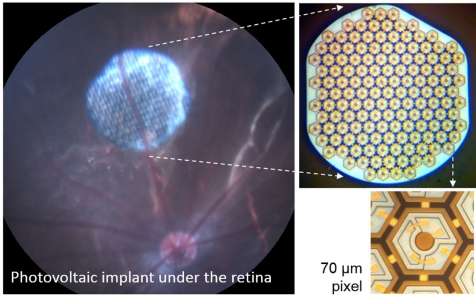 Photovoltaic retinal implant could restore functional sight, researchers say
