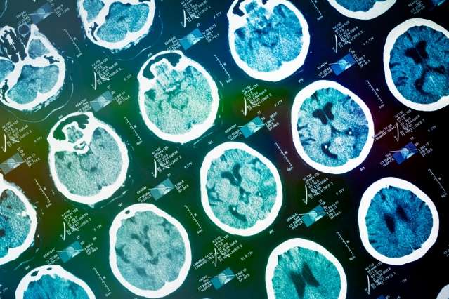 Predicting change in the Alzheimer’s brain