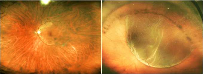 Preserving photoreceptor cells following retinal injury