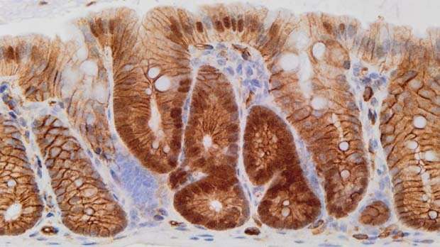 Prioritising the gene faults behind bowel cancer
