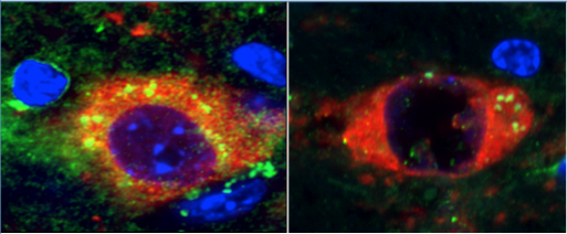 Rapamycin prevents Parkinson's in mouse model of incurable neurodegenerative disease