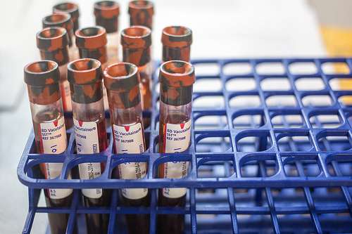 Research on cancer blood test is overhyped in the media