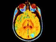 Resistance training may cut white matter lesion progression
