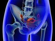 Risk of fractures reduced in polycystic ovary syndrome