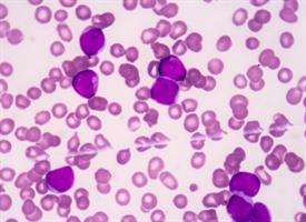Scientists aim at a genetically lethal strain of leukemia
