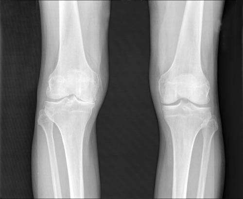 Seeing the knee in a new light: Fluorescent probe tracks osteoarthritis development