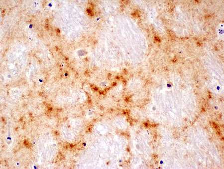 Small loop in human prion protein prevents chronic wasting disease