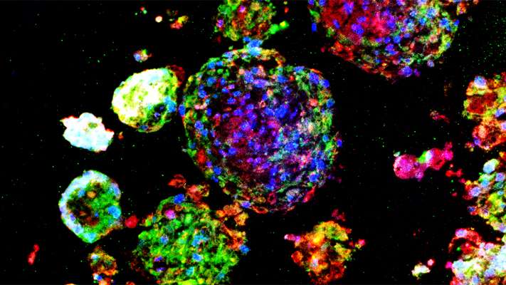 Spheroid stem cell production sows hope for IPF treatment