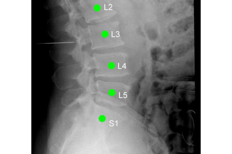 Spinal surgery: Right on target