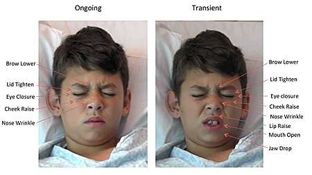 Staring pain in the face -- software 'reads kids' expressions to measure pain levels