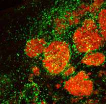Stem-cell-based therapy promising for treatment of breast cancer metastases in the brain