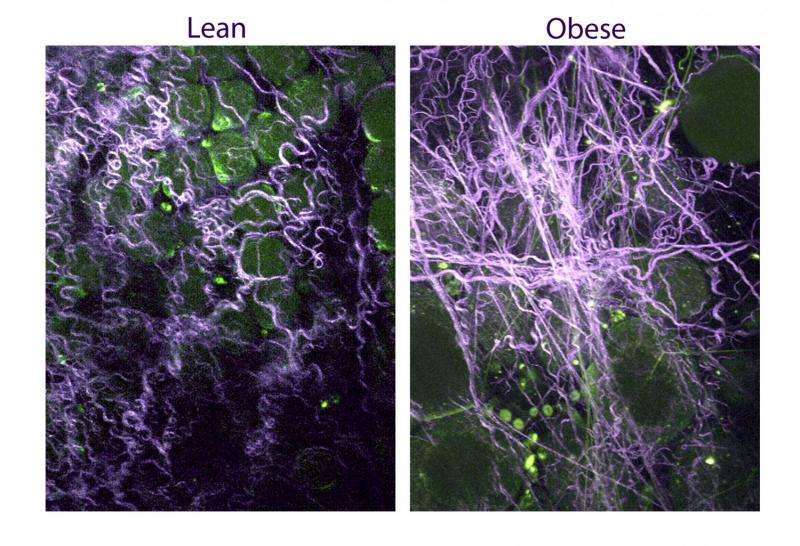 Stiffer breast tissue in obese women promotes tumors