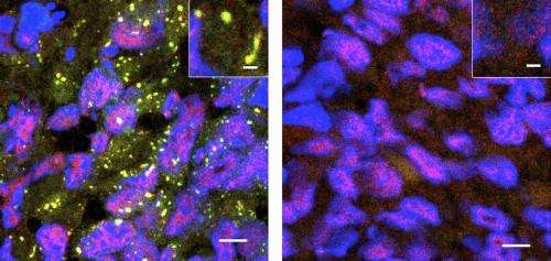Stress granules ease the way for cancer metastasis