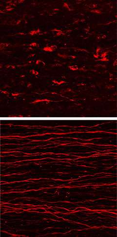 Study detailing axonal death pathway may provide drug targets for neurodegenerative diseases