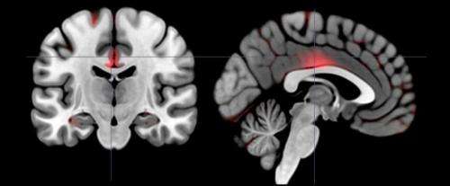 Study maps extroversion types in the brain's anatomy