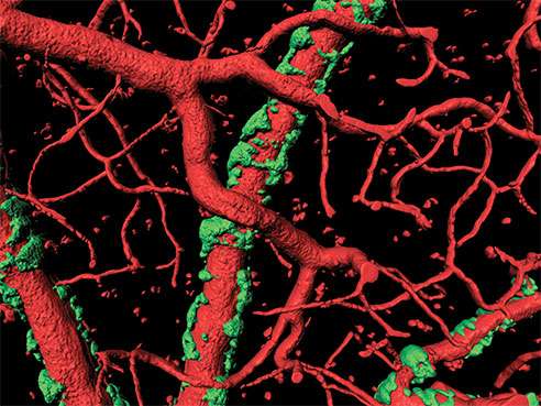 Study says Alzheimer’s plaques can also affect the brain’s blood vessels