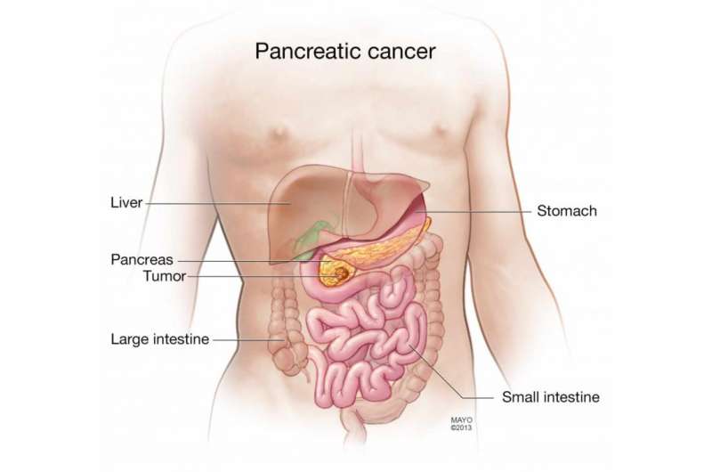 Surgery an option for more pancreatic cancer patients, Mayo expert says