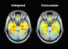 Testing of oculomotor nerve function may aid in concussion diagnosis