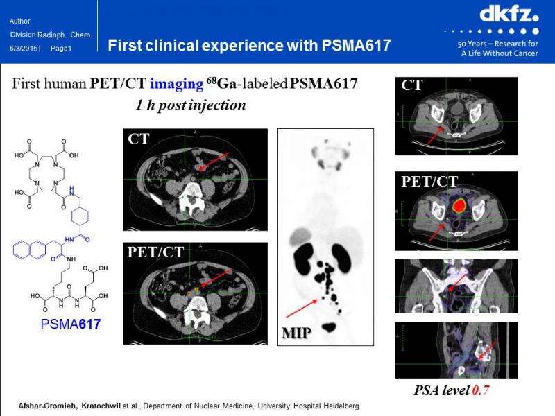 Theranostic drug personalizes prostate cancer imaging and therapy