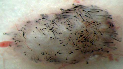Using stem cells to grow new hair
