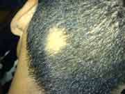 UVA-1 promising for patients with refractory alopecia areata