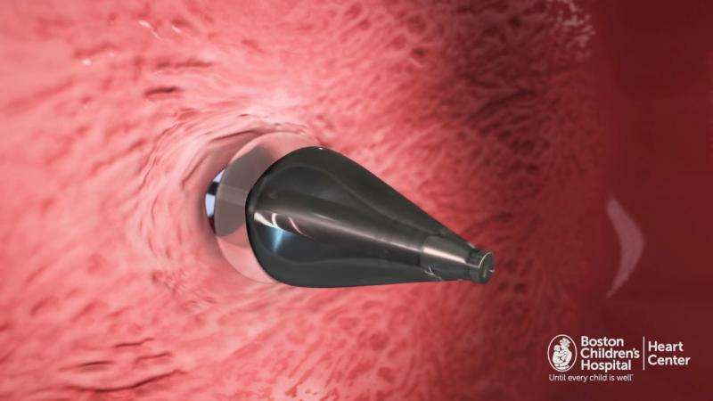 UV-light enabled catheter fixes holes in the heart without invasive surgery