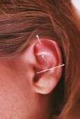 Various dermatoses may occur after acupuncture