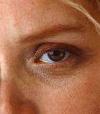 Why skin wrinkles more around the eyes