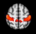 Youth on the autism spectrum overly sensitive to sensory stimuli have brains that react differently