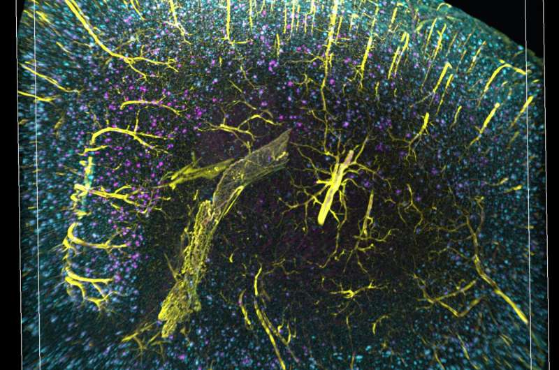 3-D imaging reveals unexpected arrangement of plaques in Alzheimer's-afflicted brains
