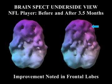 Abnormally low blood flow indicates damage to NFL players' brains