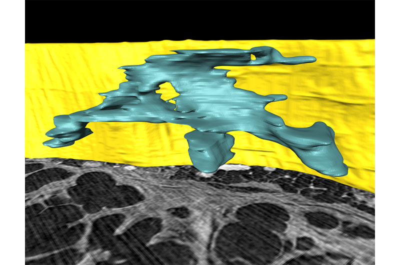 Advanced 3-D imaging technique applied for the first time to deadly lung disease