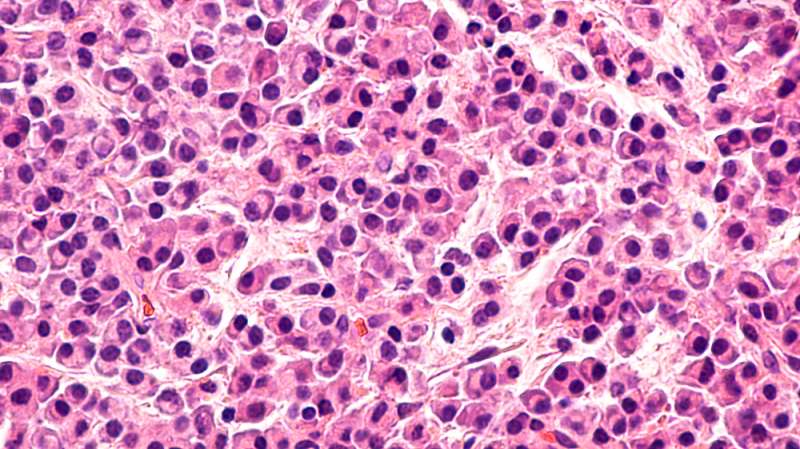 Aggressive form of leukemia linked to defective 'protein factory'