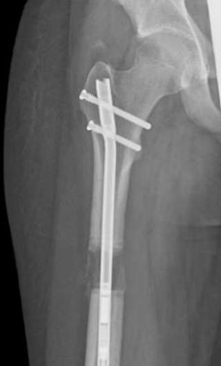 Bone-lengthening device reduces pain, infection risk
