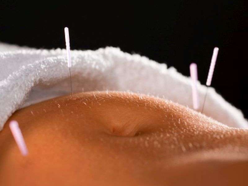 Can acupuncture ease severe constipation?