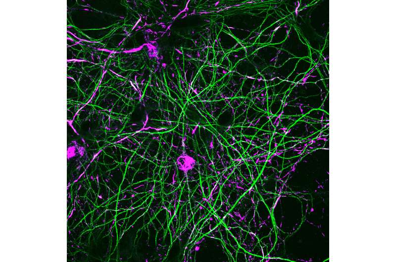 Discovery may lead to a treatment to slow Parkinson's disease