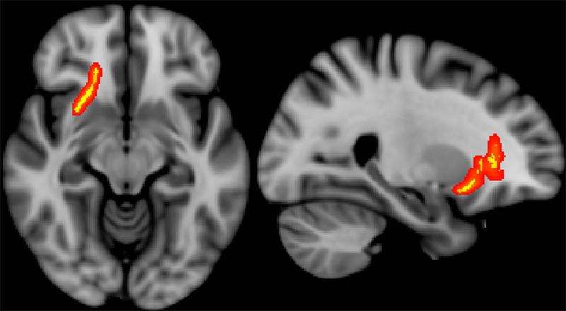 Imaging predicts long-term effects in veterans with brain injury