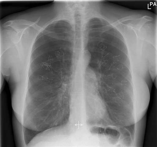 Implanted coils help some lung disease patients, study says