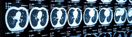 Major breakthrough in new MRI scan technology for lung disease