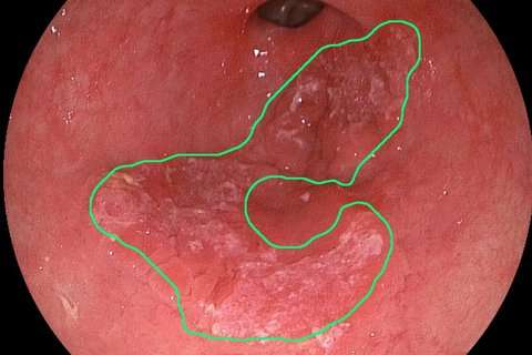 New detection method paves the way for 100% detection of esophageal cancer