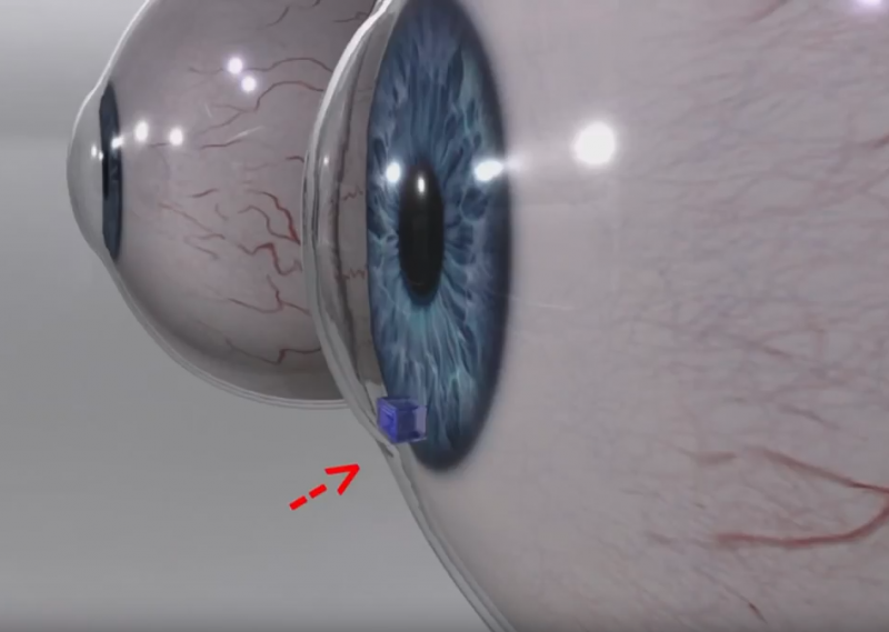 New device could save glaucoma patients’ eyesight