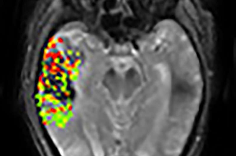 New imaging method may predict risk of post-treatment brain bleeding after stroke