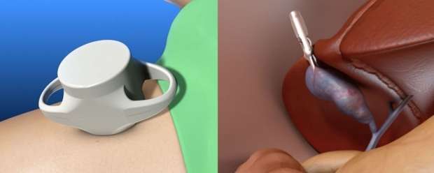New magnetic tool enables fewer incisions in gallbladder surgery